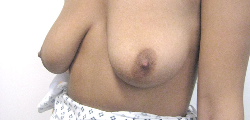Before breast asymmetry procedure